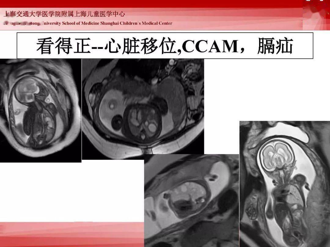 胎儿磁共振的检查技术