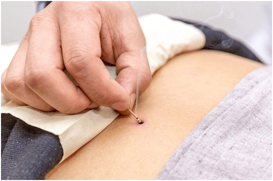 善医业务61灸法中医非药物疗法之麦粒灸