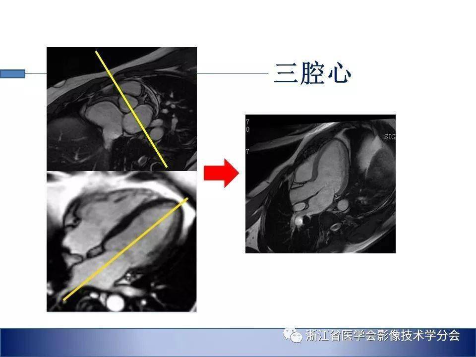 心臟磁共振掃描技術要點及偽影控制策略