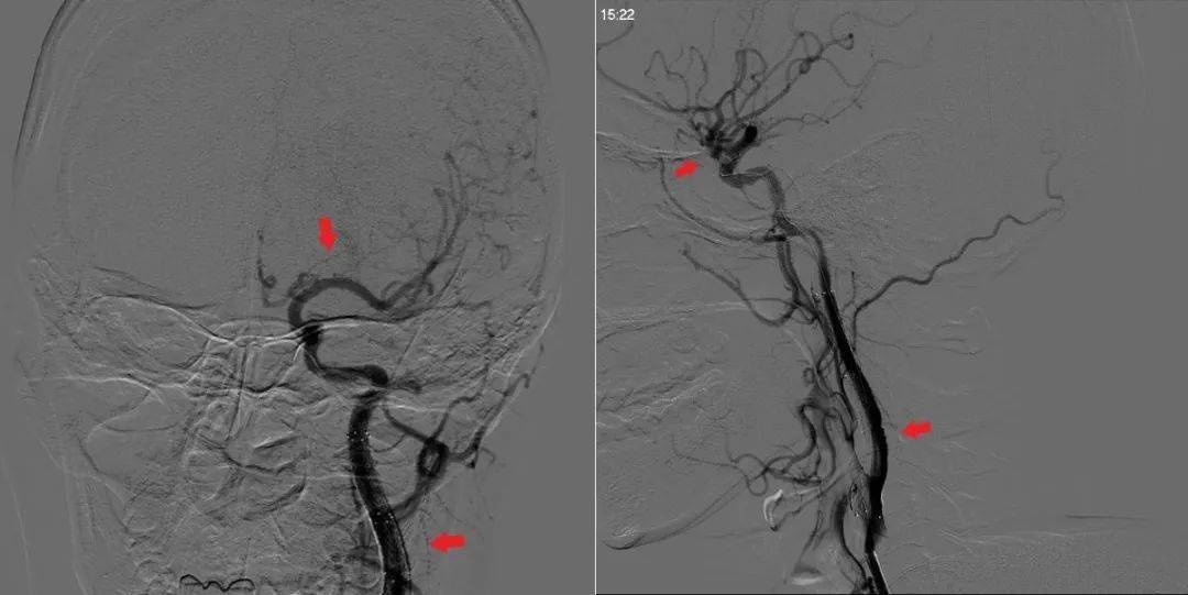 更令人驚愕的是,術中造影竟印證了醫生的猜測: 患者存在頸動脈夾層!