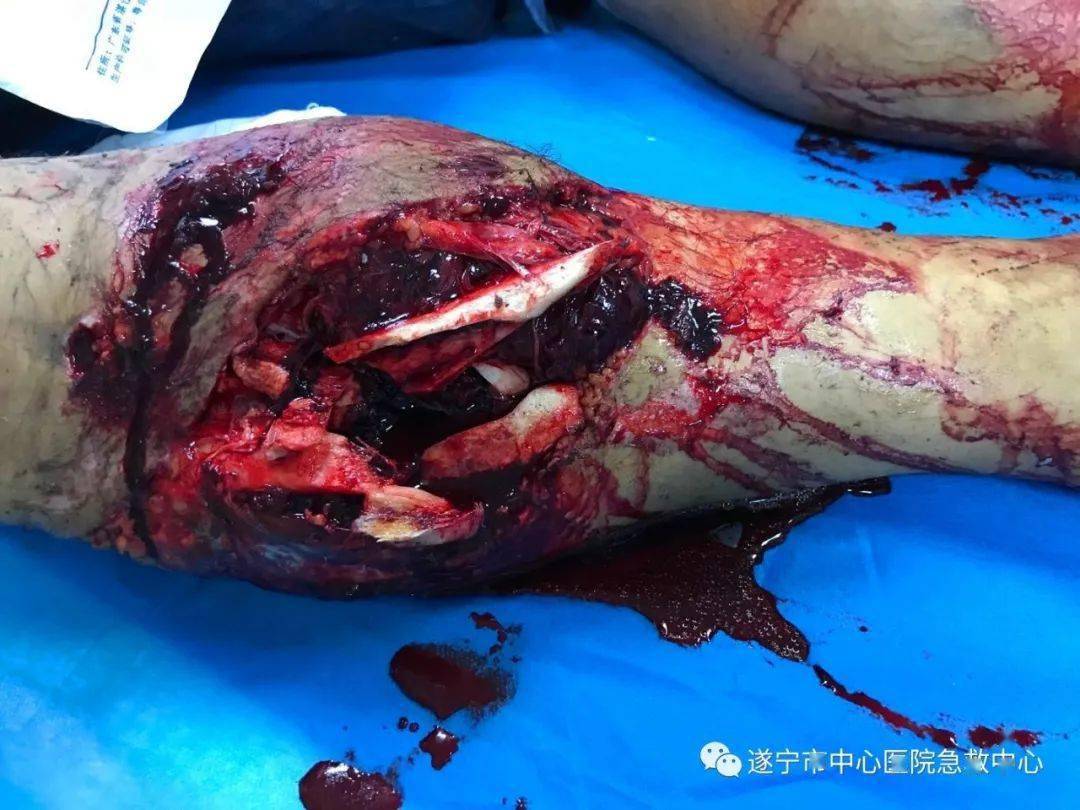 我院多学科创伤团队又成功救治一例危重创伤患者!