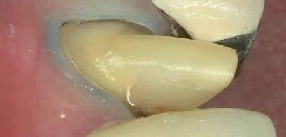 【牙医学堂】牙体制备中排龈线的使用方法_预备