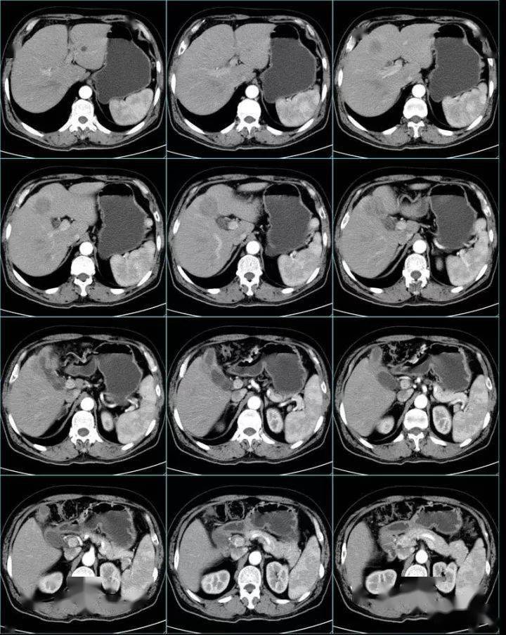 黄色肉芽肿性胆囊炎病例!