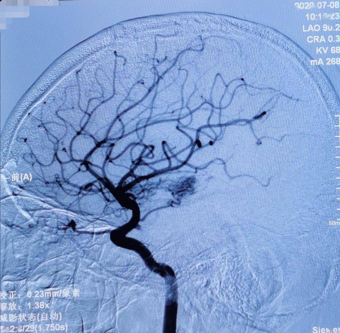 短期內再出血的風險,以及制定下一步治療策略,必須做腦血管造影(dsa)
