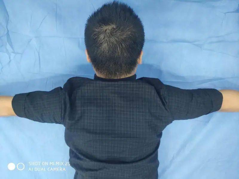 天使之翼不美丽浅谈翼状肩胛