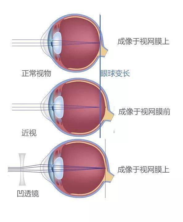 原來近視手術就是切個西瓜