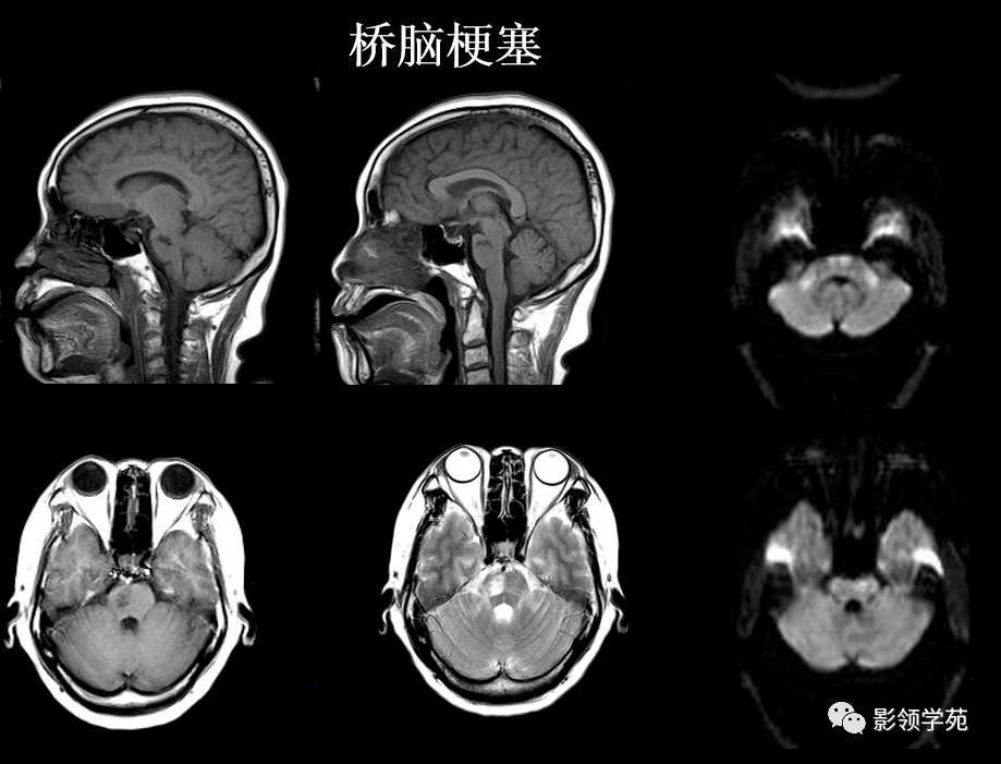 10种脑干区常见病变影像表现