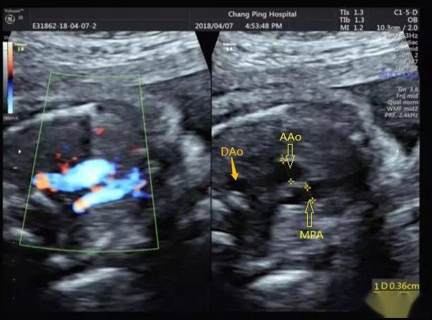 超声典型病例胎儿法洛四联症合并右位主动脉弓