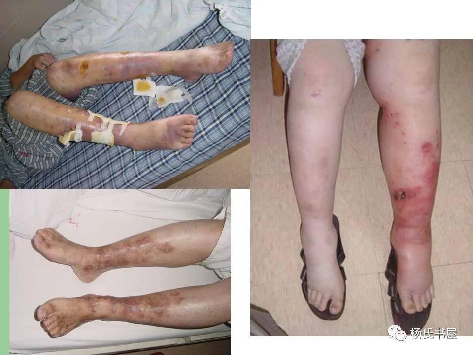 精彩课件换个角度看系统性血管炎