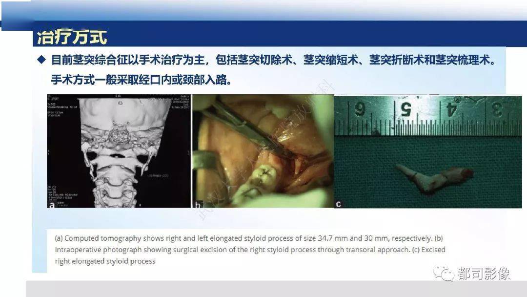 茎突综合征影像诊断