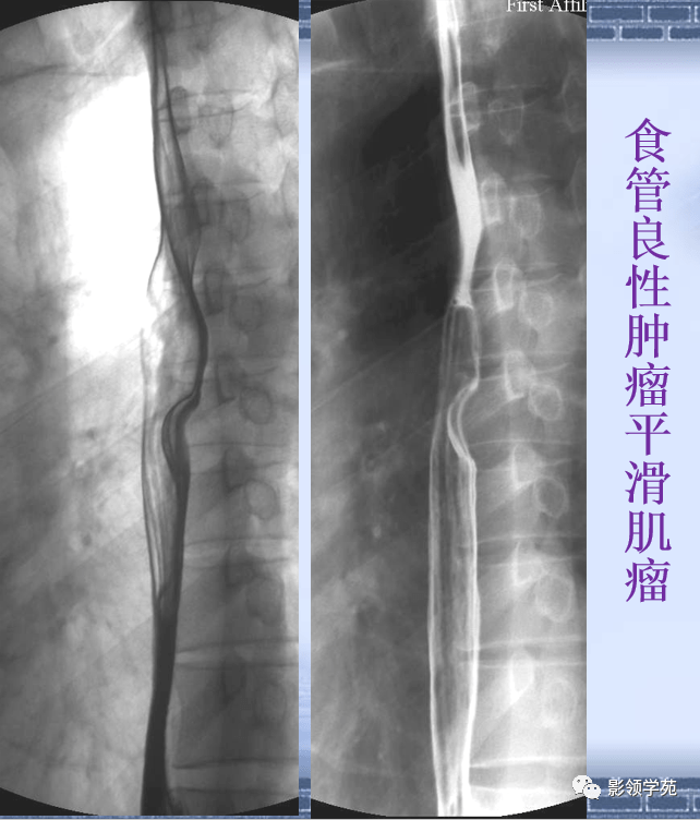 食管平滑肌瘤x线图片