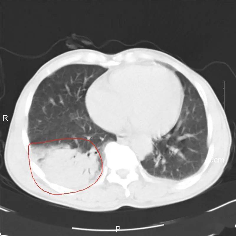 呼吸内科主任孙亚红判断,老刘患上了肺炎,同时有特殊病原菌感染的可能