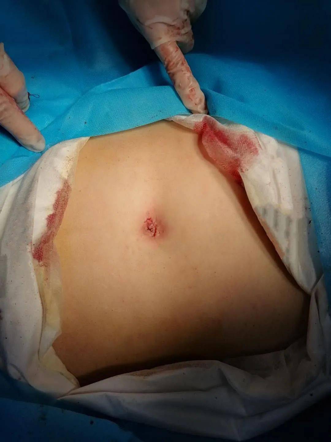 宫外孕微创手术伤口图图片