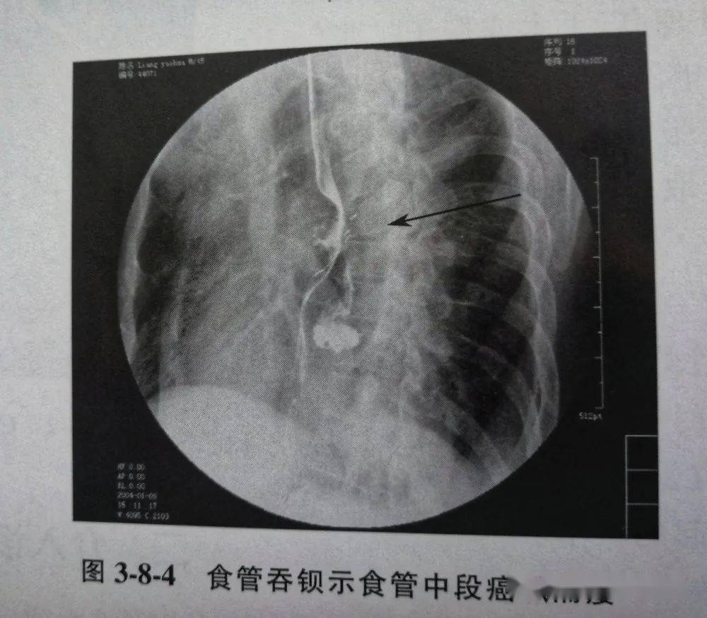 良性食管狭窄 食管灼伤后狭窄,反流性食管炎所致的瘢痕狭窄,贲门失驰