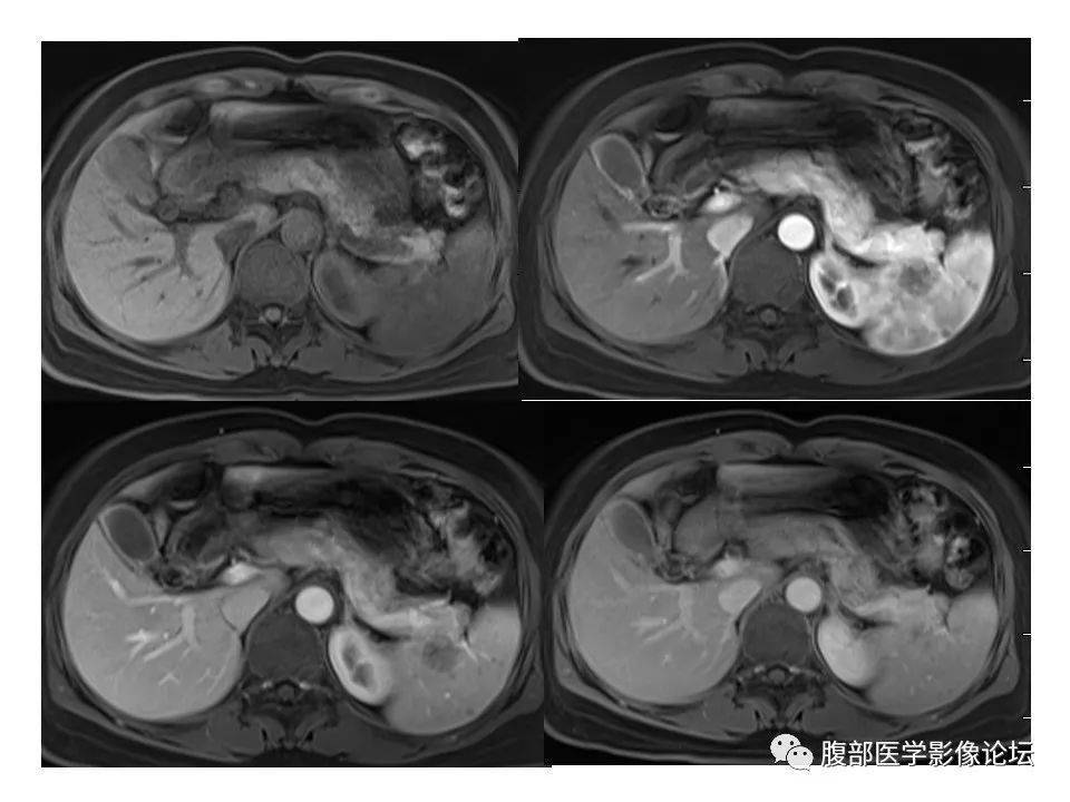 脾脏丨弥漫性大b细胞淋巴瘤两例