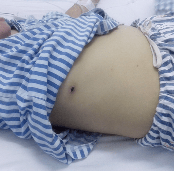 警惕夏季杀手之一---恙虫病!