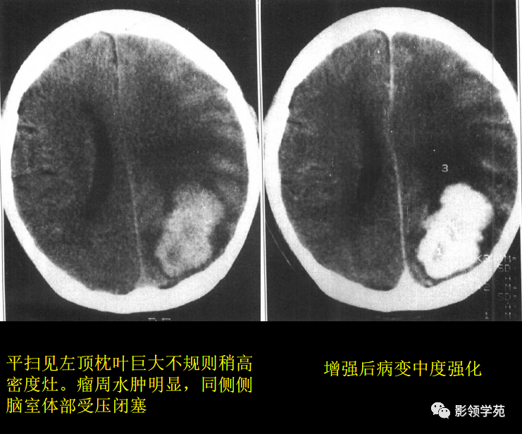 15中常见颅内肿瘤的ct表现_钙化