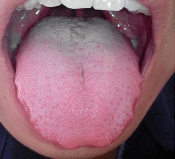 舌头根部长痘痘图片图片