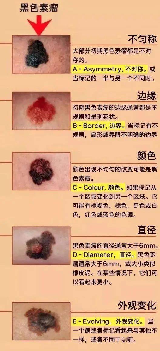 警惕黑痣癌变会发出这5个信号