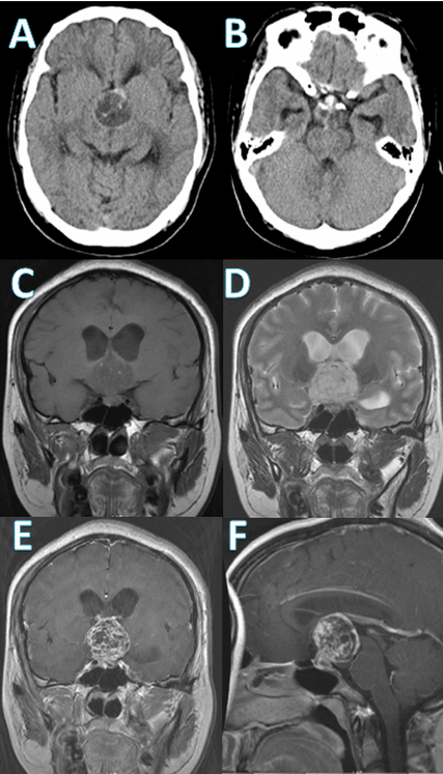 病例分享内镜下经鼻蝶切除鞍上巨大实质性颅咽管瘤一例神经内镜系列三