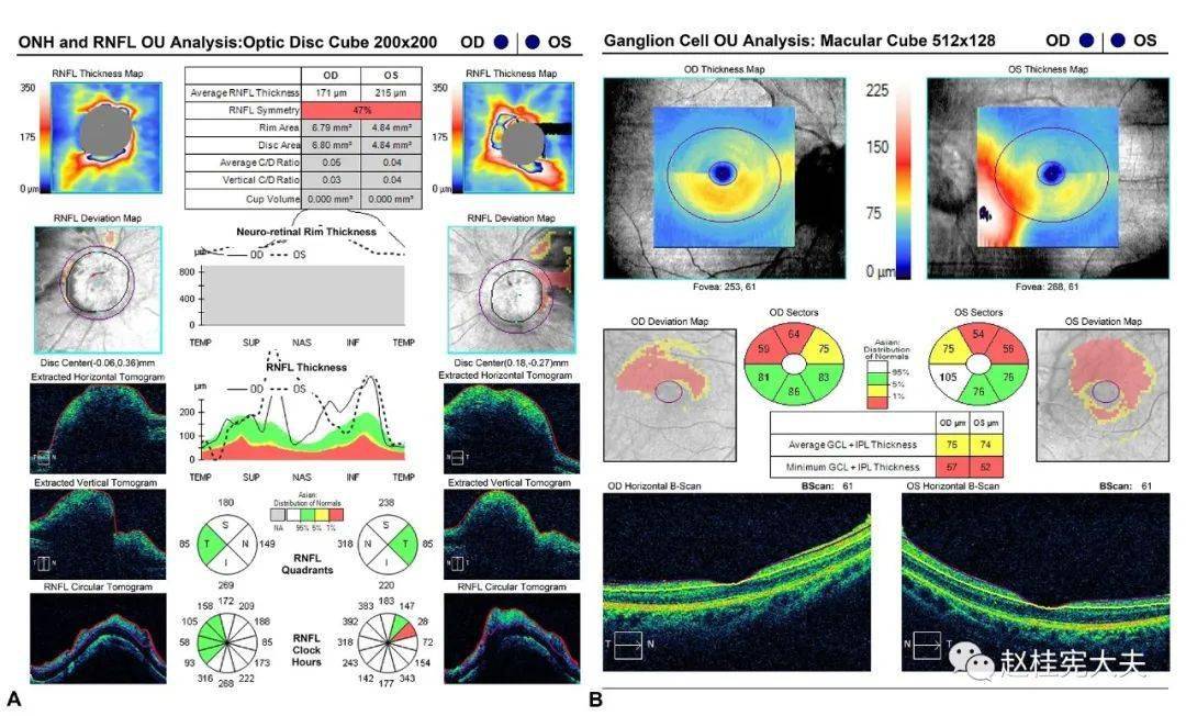 1例特发性颅高压患者的诊治经过及分析