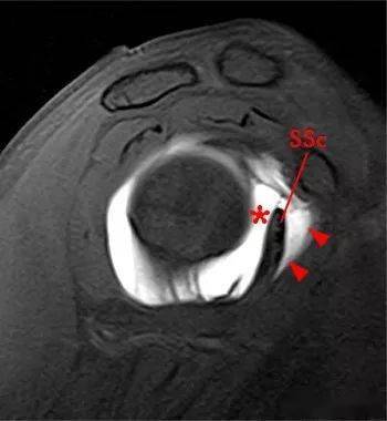 肩峰下滑囊积液图片