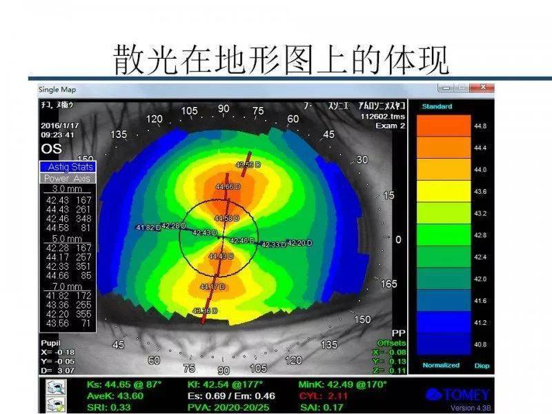 眼视光角膜地形图阅读及基本使用