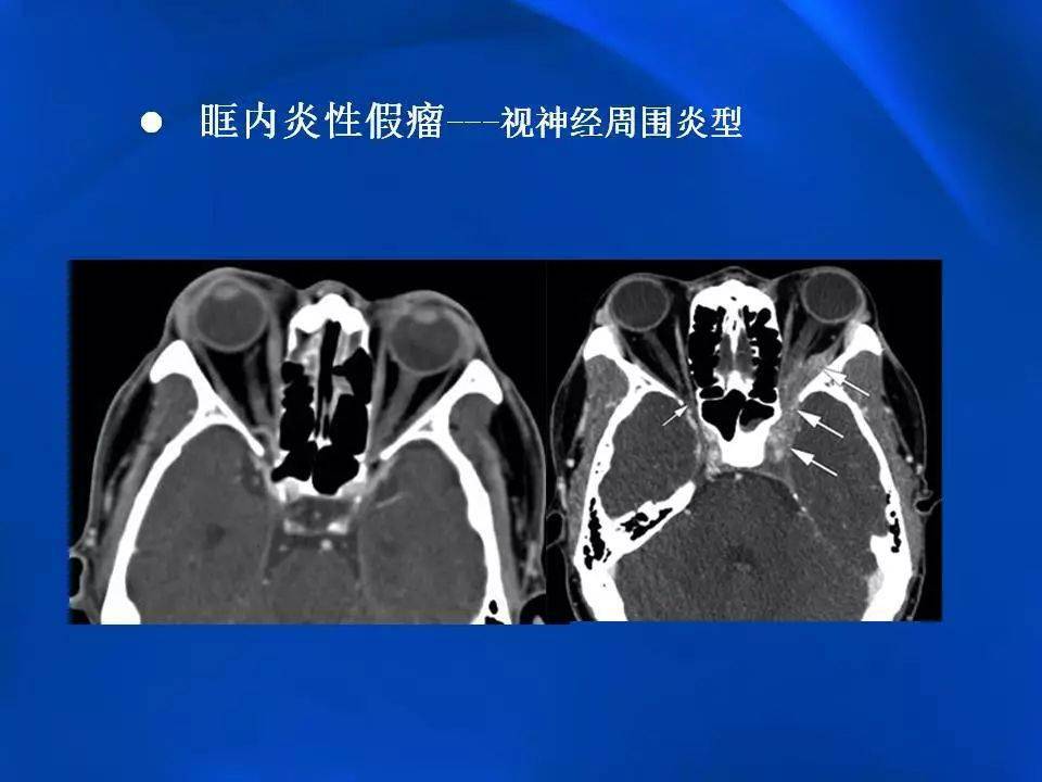 眶内炎性假瘤影像学表现
