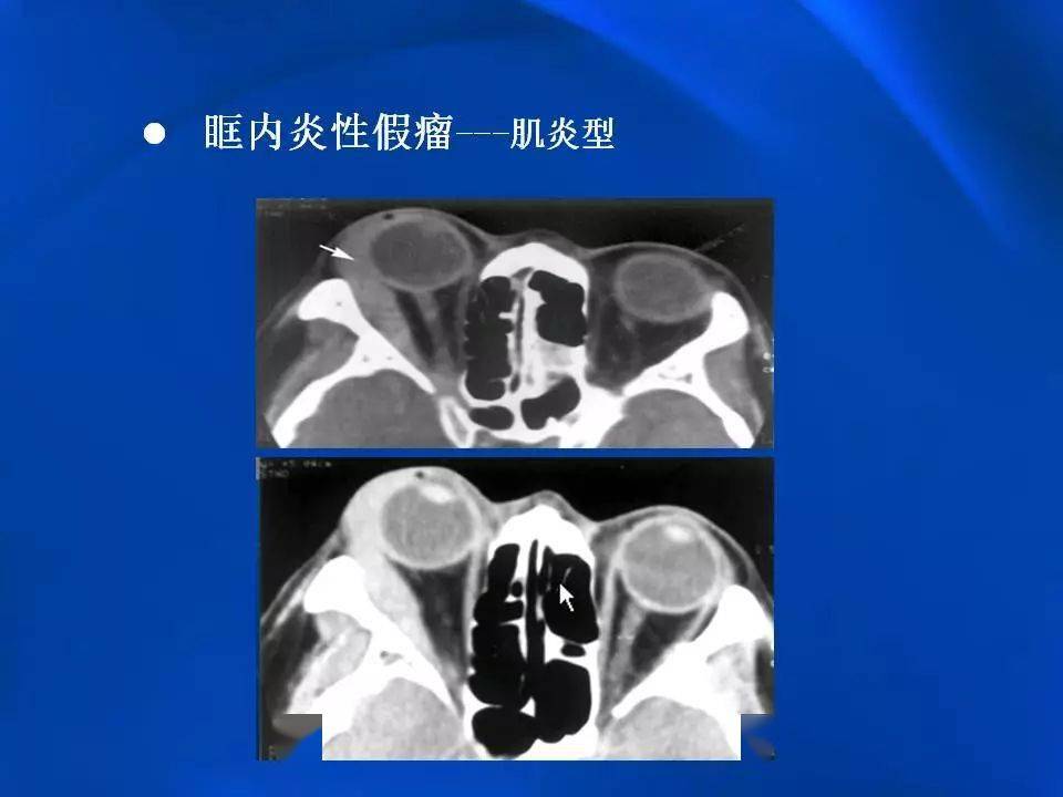 眶内炎性假瘤影像学表现