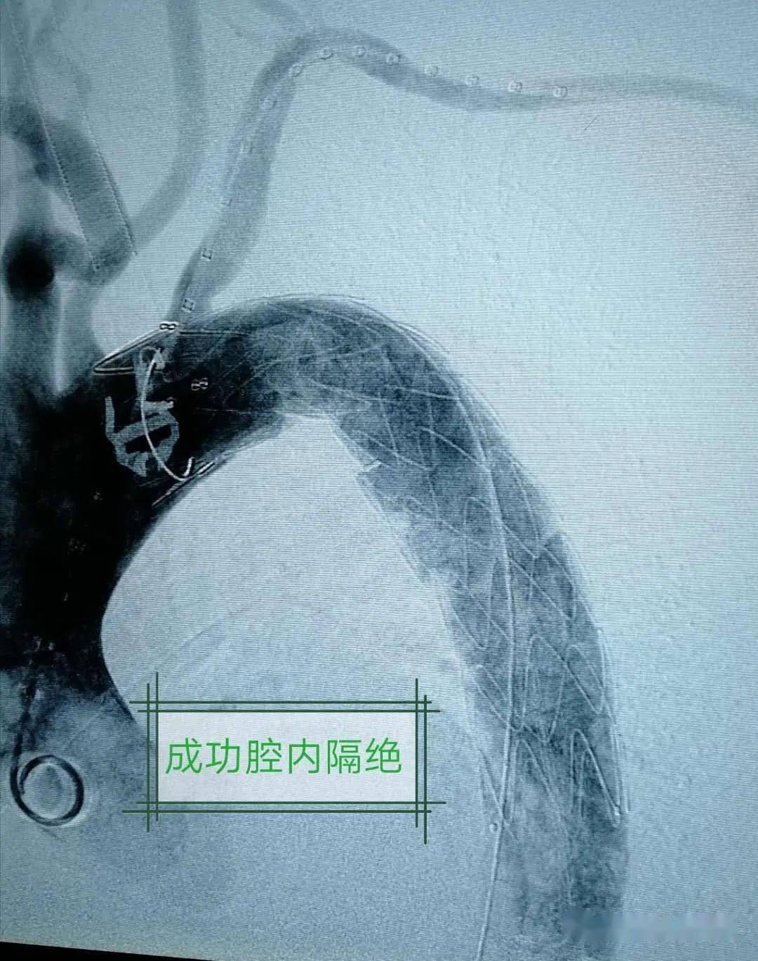 临城县人民医院成功完成首例胸主动脉夹层覆膜支架腔内隔绝术