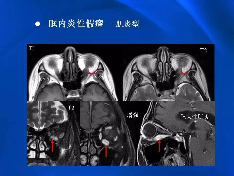 眶内炎性假瘤影像学表现