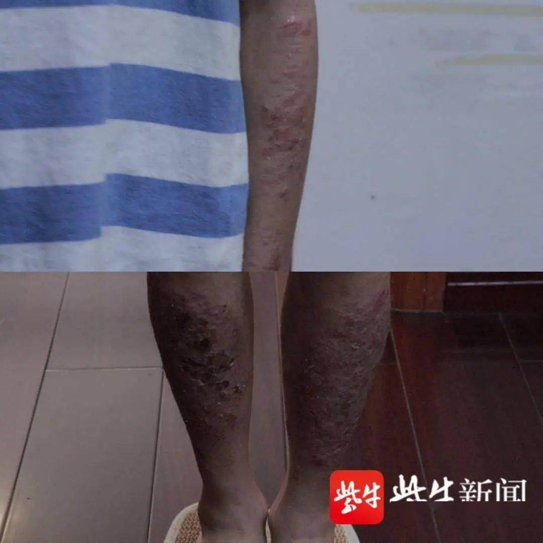 全身皮肤溃烂奇痒难忍7岁男孩染怪病辗转7家医院无果