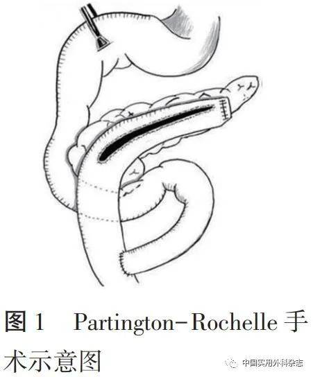 引流术式(partington-rochelle胰管空肠侧侧吻合术,如图1所示),切除术