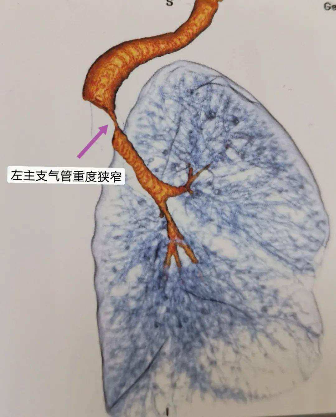 妙手仁心解危难中心医院介入科施行气管支架成功救治气管重度狭窄患者
