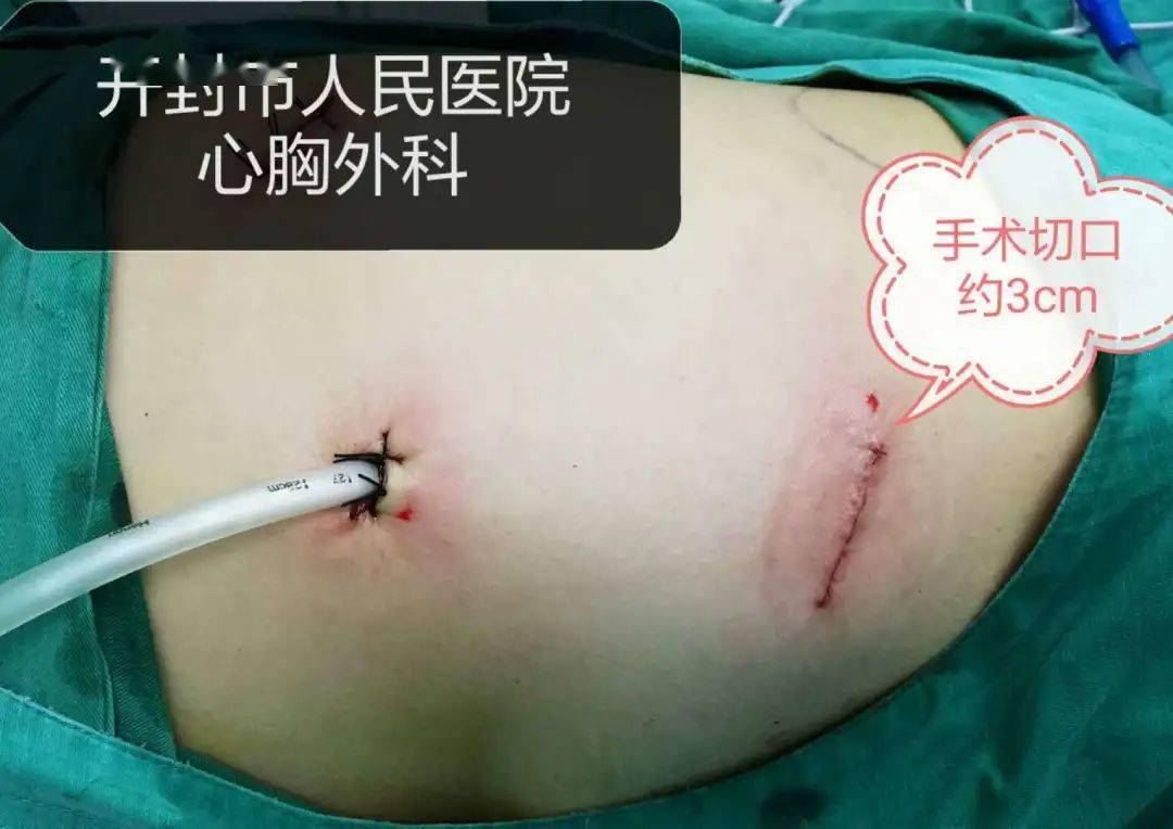 肺结节不纠结