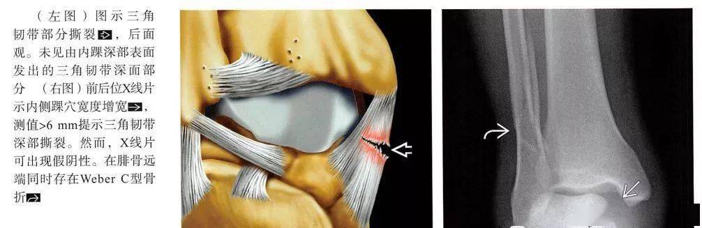 这样来看三角韧带,不会都难