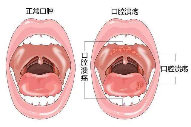 口腔溃疡唇炎原来都与这个门诊有关