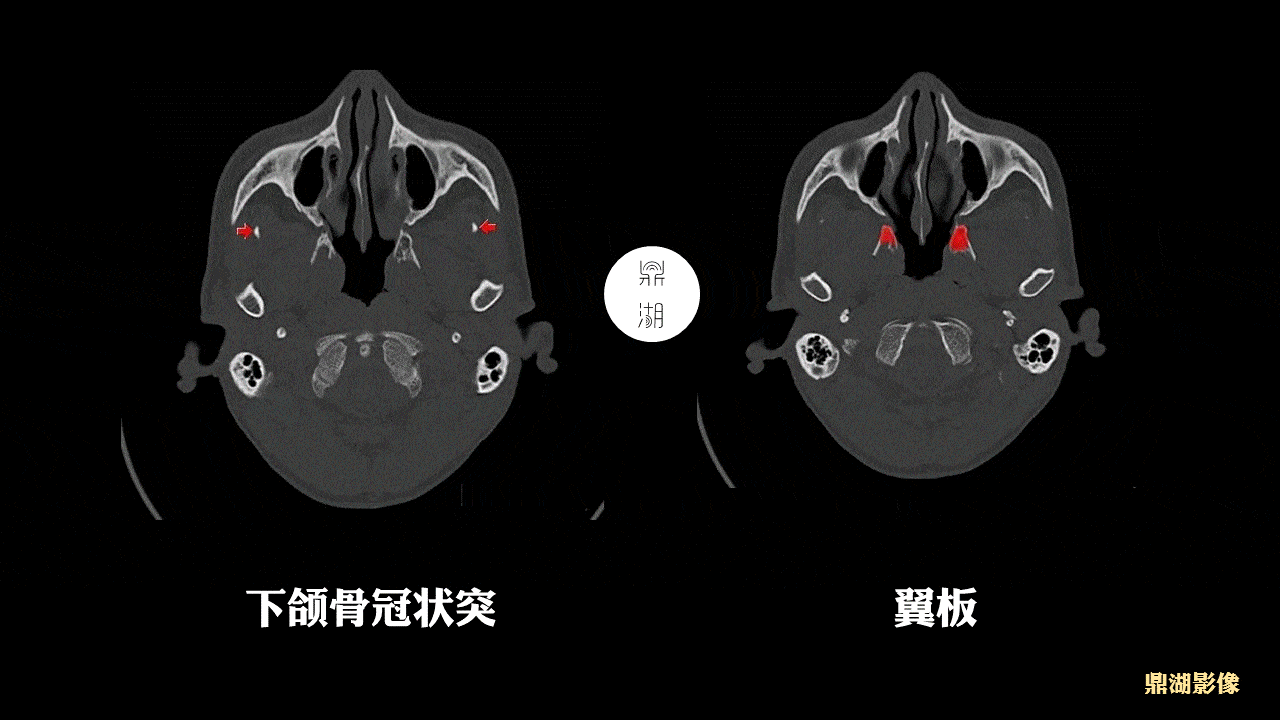 颧骨断层解剖图图片