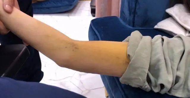 万茜车祸伤口首曝光,手臂淤青疤痕长到吓人,复健举500g都费劲?