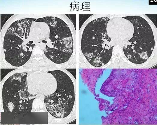 肺部烟花征的影像表现与鉴别诊断