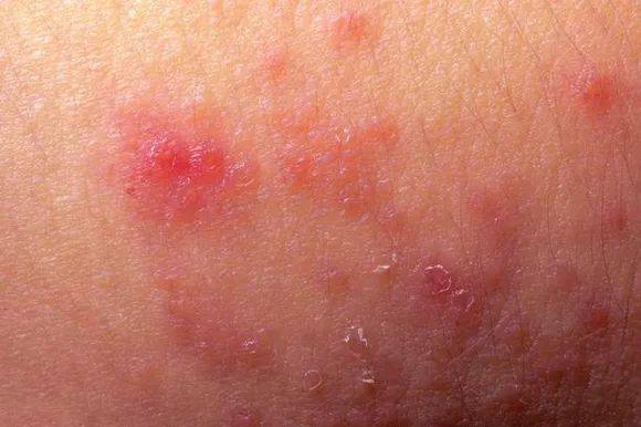 皮肤病课堂夏季皮肤瘙痒常见的3种情况