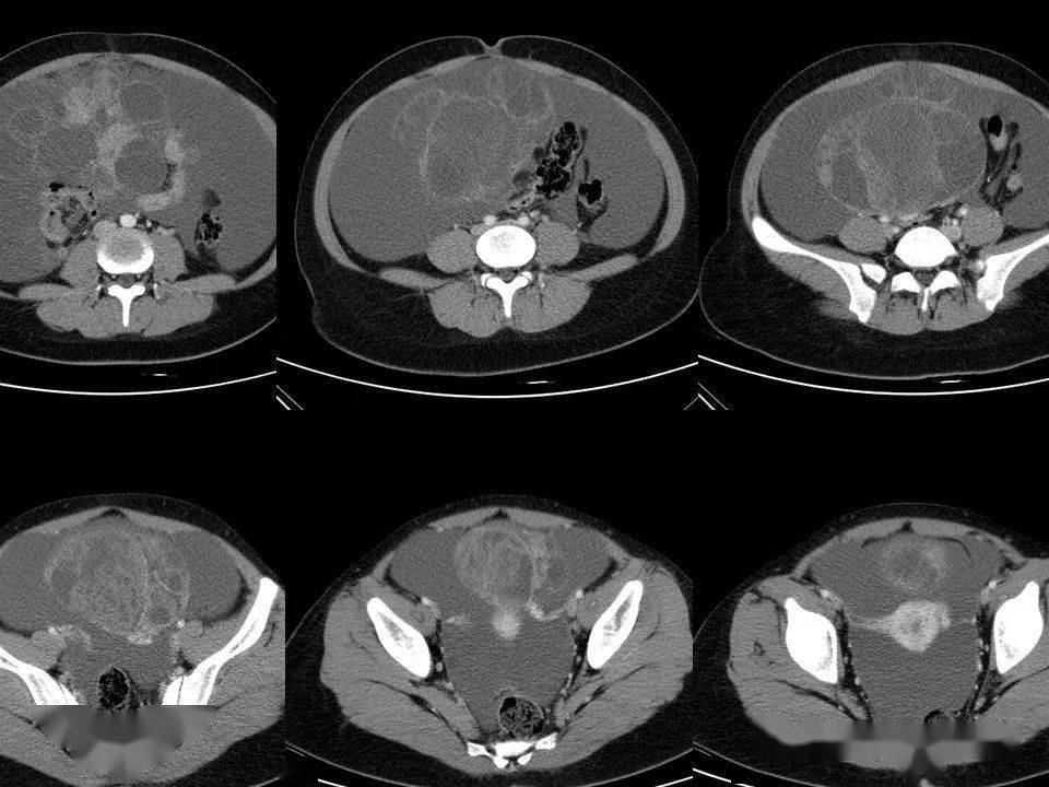 卵巢囊腺瘤CT图片