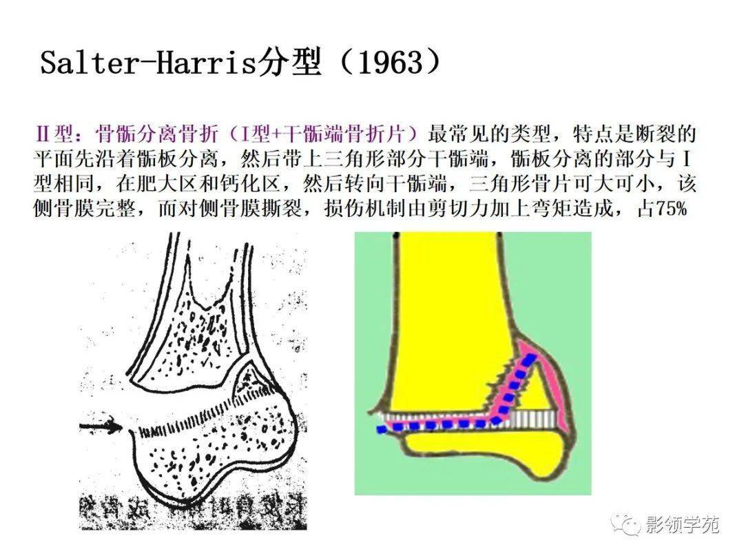 儿童肩关节骨骺图片图片