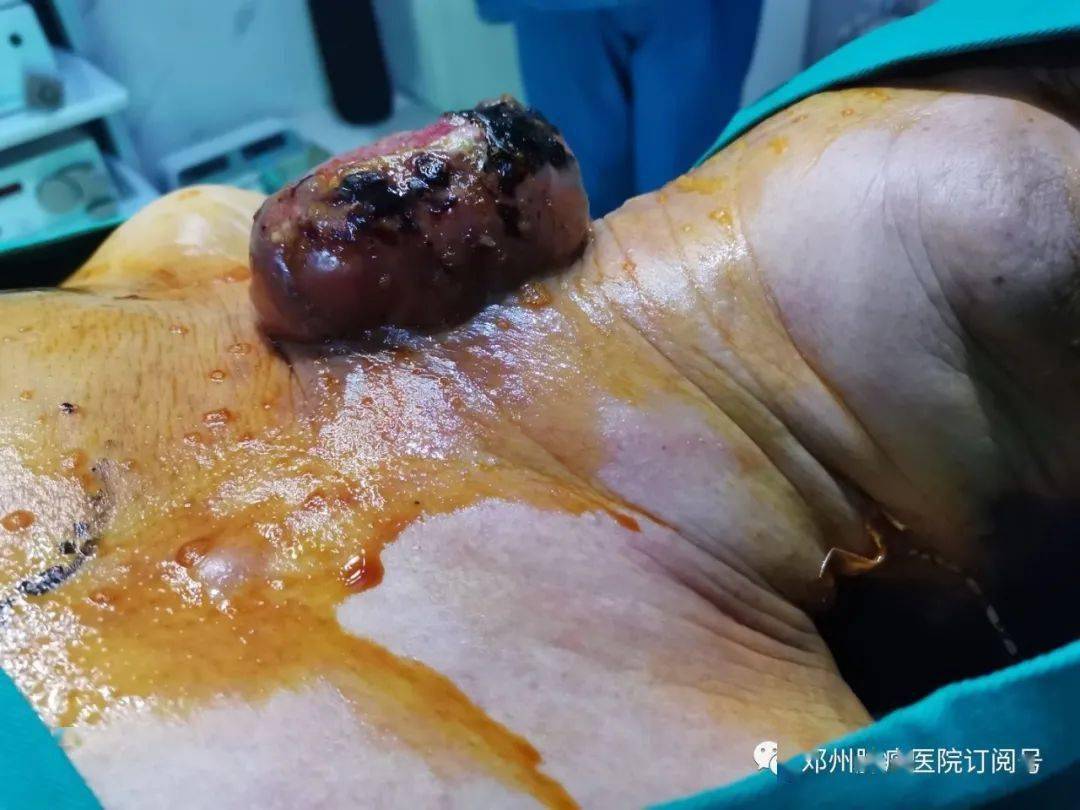 感谢信巨型恶瘤折磨7旬老妪多年邓州肿瘤医院妙手除恶疾获赞