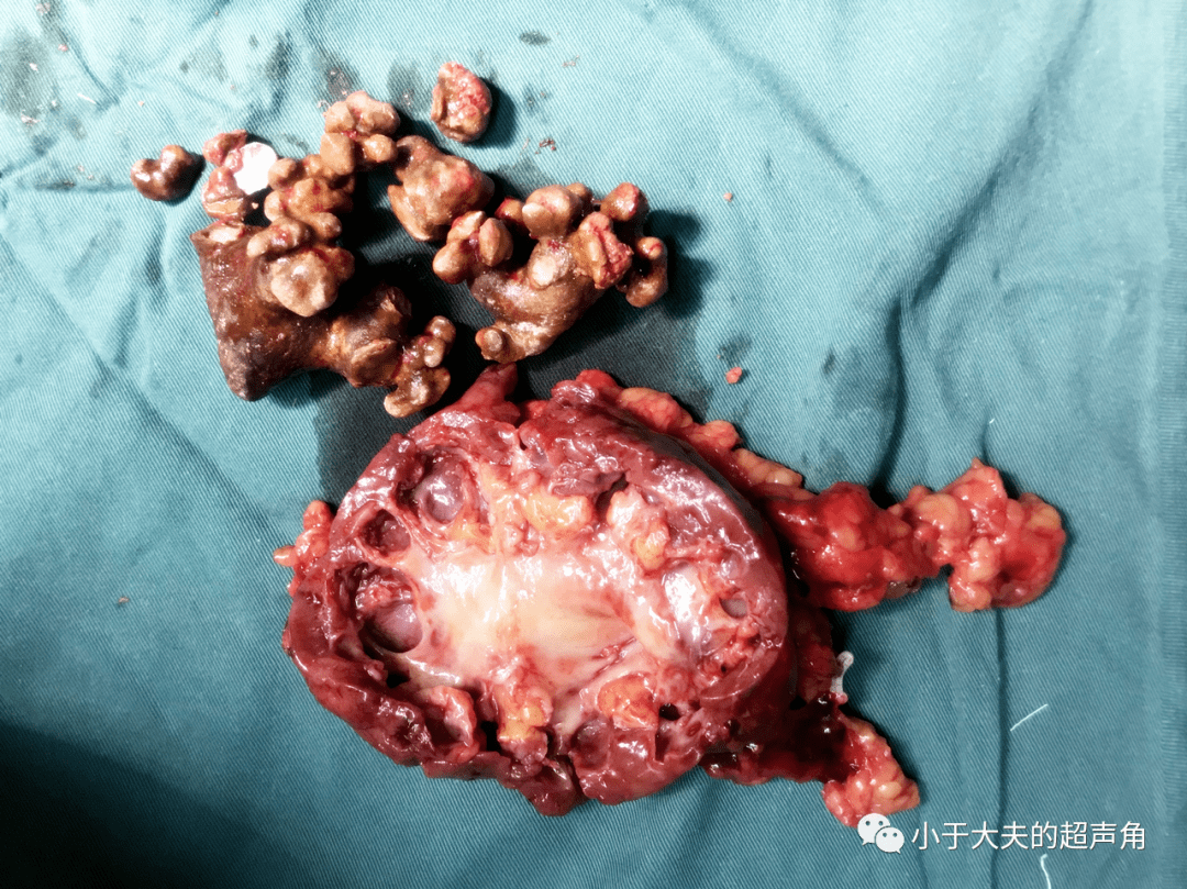 肾窦区结石图片