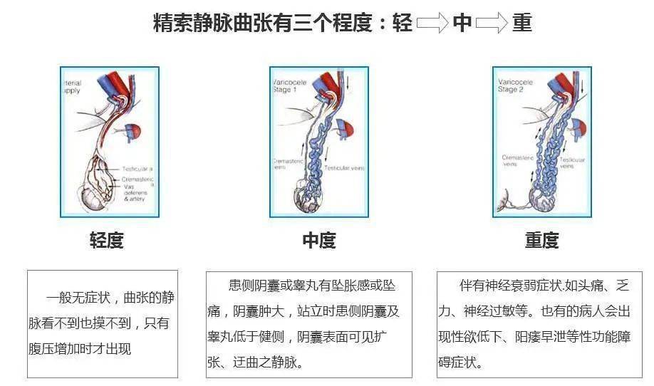 蛋蛋的忧伤你懂吗精索静脉曲张的手术治疗方式你有几种选择