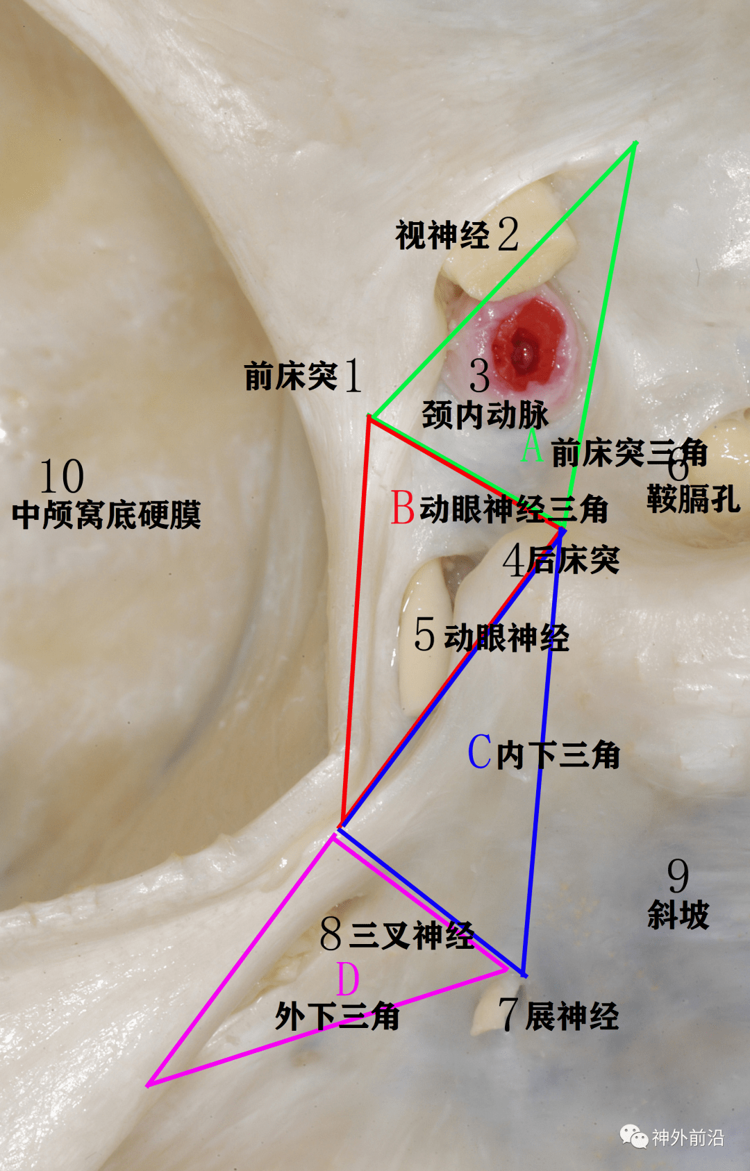 鞍侧室(海绵窦)之一