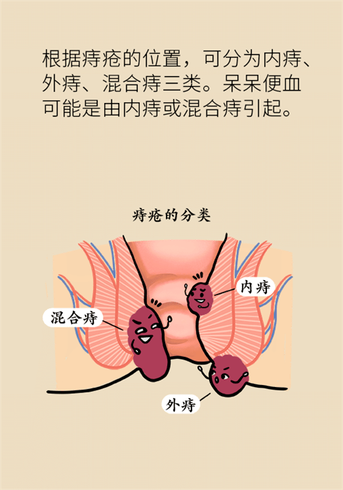 【今日健康】肛門腫脹還有血?小心痔瘡找上門