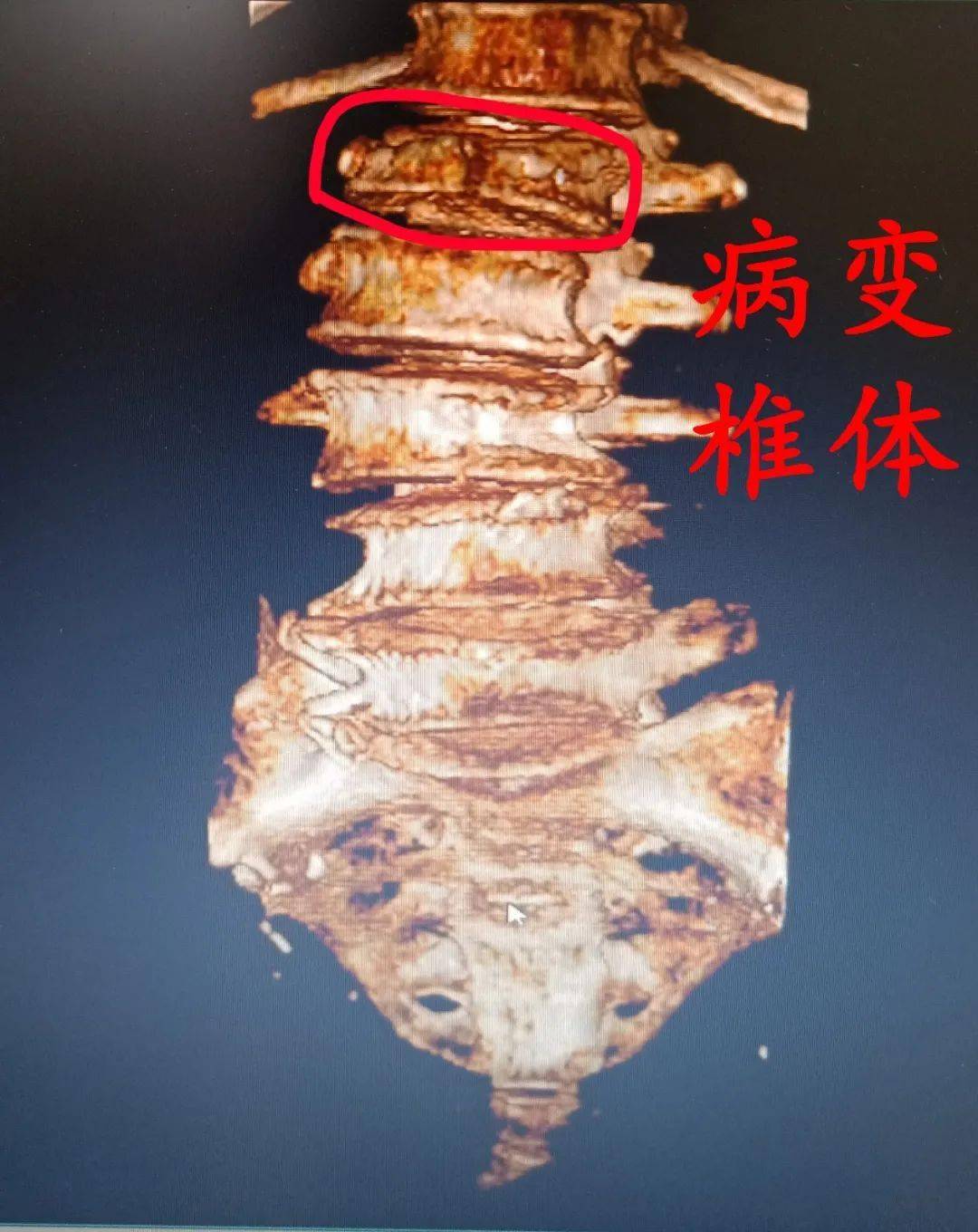 性骨折,经相关辅助检查最终确诊为腰椎骨质疏松性椎体压缩骨折(l1)