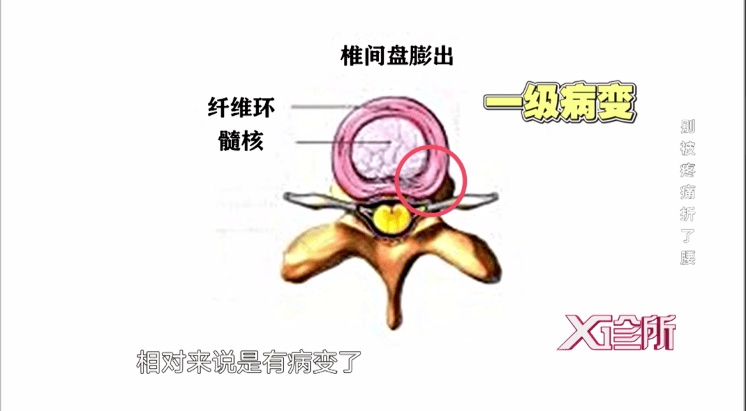 椎间盘膨出图片图解图片